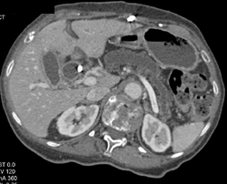 Common Bile Duct (CBD) Stent - CTisus CT Scan