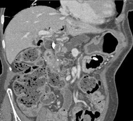 Pancreatic Cancer With A Huge Pancreatic Duct - CTisus CT Scan