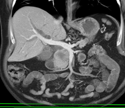 Pancreatic Adenocarcinoma - CTisus CT Scan