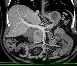 Pancreatic Adenocarcinoma - CTisus CT Scan