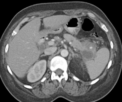 Pseudoaneurysm in the Tail of the Pancreas Near A Pseudocyst - CTisus CT Scan