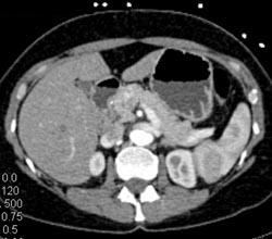 5 Mm Insulinoma in Pancreatic Head - CTisus CT Scan