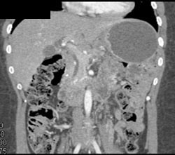 Normal Pancreatic Head - CTisus CT Scan