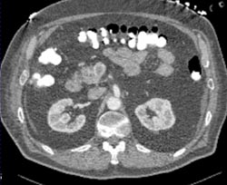 Portal Vein Thrombosis (PVT) and Superior Mesenteric Vein (SMV) Clot - CTisus CT Scan