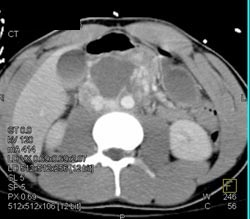 Testicular Carcinoma Simulates A Pseudocyst - CTisus CT Scan