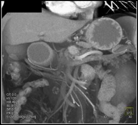 1 Cm Pancreatic Cancer With Distal Gland Atrophy - CTisus CT Scan