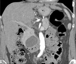 Pseudocyst Vs Cystadenoma - CTisus CT Scan