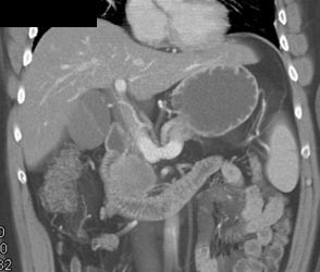 Carcinoma of the Head of the Pancreas - CTisus CT Scan