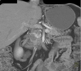 Carcinoma Arises in An Intraductal Papillary Mucinous Neoplasm (IPMN) - CTisus CT Scan