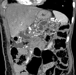 Intraductal Papillary Mucinous Neoplasm (IPMN) Vs Cystadenoma- IPMN It Is! - CTisus CT Scan