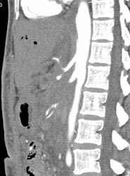 Pancreatic Cancer Encases the SMA - CTisus CT Scan