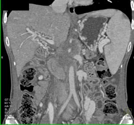 Pancreatic Cancer Encases the PV/SMV With Collaterals - CTisus CT Scan