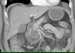 Intraductal Papillary Mucinous Neoplasm (IPMN) - CTisus CT Scan