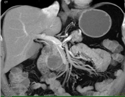 Intraductal Papillary Mucinous Neoplasm (IPMN) - CTisus CT Scan