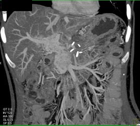 Pancreatic Cancer With SMA Encasement and Cavernous Transformation of the Portal Vein (CTPV) - CTisus CT Scan