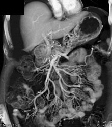 Recurrent Pancreatic Cancer Encases the PV/SMV Confluence - CTisus CT Scan