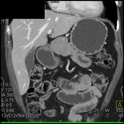 Castleman Disease Simulates A Pancreatic Mass - CTisus CT Scan