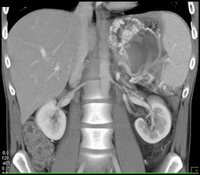 Pseudocysts Compress and Occlude the Splenic Vein With Collaterals and Varices - CTisus CT Scan