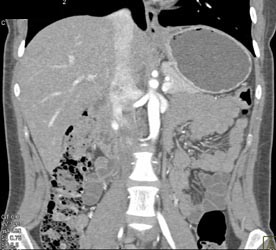 Normal Pancreas - CTisus CT Scan