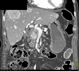 Metastatic Islet Cell Tumor to Liver - CTisus CT Scan