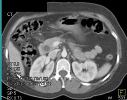 Dilated Common Bile Duct Due to Stone - CTisus CT Scan