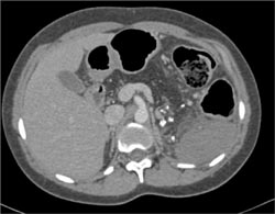 Cystic Fibrosis With Fatty Replacement of the Gland - CTisus CT Scan