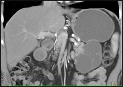 Cystadenoma - CTisus CT Scan