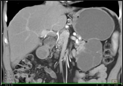 Cystadenoma - CTisus CT Scan