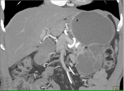 Cystadenoma - CTisus CT Scan