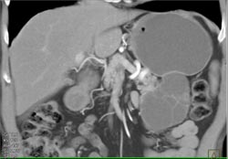 Cystadenoma - CTisus CT Scan