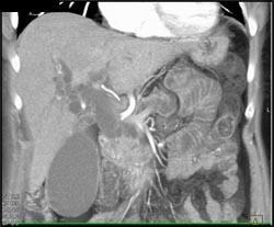 Pancreatic Cancer With Dilated Common Bile Duct (CBD) and Pancreatic Duct - CTisus CT Scan