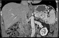 Islet Cell Tumor Occludes the Splenic Vein - CTisus CT Scan