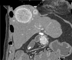 Islet Cell of the Pancreas Metastatic to the Liver - CTisus CT Scan