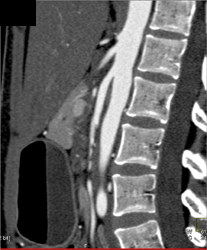 Intraductal Papillary Mucinous Neoplasm (IPMN) and SMA Syndrome - CTisus CT Scan