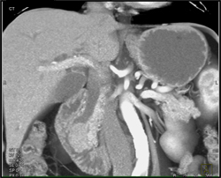 Ampullary Carcinoma With Dilated Common Bile Duct (CBD) - CTisus CT Scan