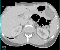 Cystadenoma - CTisus CT Scan