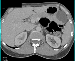 Cystadenoma - CTisus CT Scan