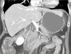 Lipoma of Pancreas - CTisus CT Scan