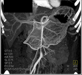 Mucinous Cystadenocarcinoma - CTisus CT Scan