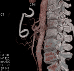 Pseudocyst With Internal Drain Through Stomach - CTisus CT Scan