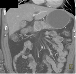 Cystadenoma - CTisus CT Scan