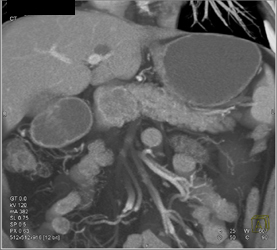 Cystadenoma - CTisus CT Scan