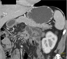 3 Mm Intraductal Papillary Mucinous Neoplasm (IPMN) - CTisus CT Scan