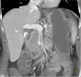 Adenocarcinoma of the Pancreas Encases the Superior Mesenteric Vein (SMV) - CTisus CT Scan