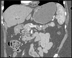 Insulinoma of the Pancreatic Tail - CTisus CT Scan