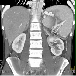 Pseudocyst Compresses the Splenic Vein With Extensive Collaterals - CTisus CT Scan