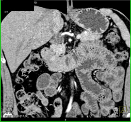 Duodenal Carcinoma Simulated A Pancreatic Mass - CTisus CT Scan