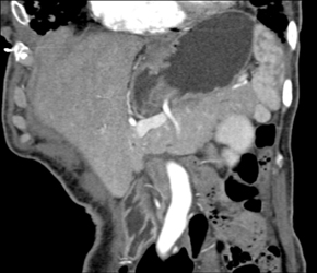 Accessory Spleen - CTisus CT Scan