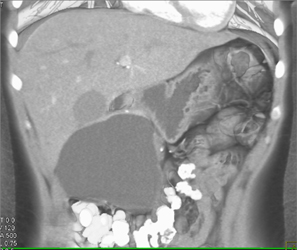 Cystadenoma - CTisus CT Scan