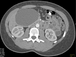 Cystadenoma - CTisus CT Scan